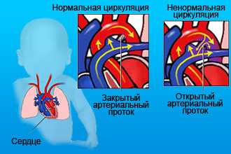 Ненормальная циркуляция сердца плода