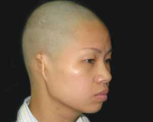 Аномалии развития наружного уха