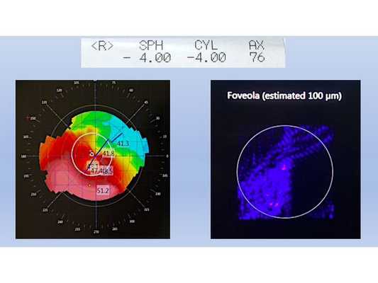 Данные рефрактометрии, кератотопографии и аберрометрии до подбора склеральной линзы