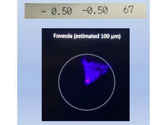 Данные рефрактометрии и аберрометрии на фоне ношения склеральной линзы