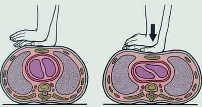 Непрямой массаж сердца