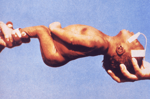 Стобняк вследствие инфекции Сlostridium tetani 