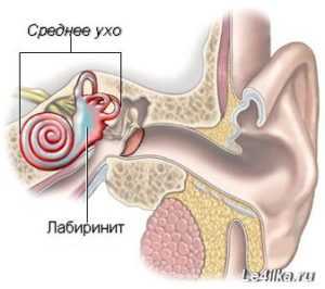 Лабиринтит