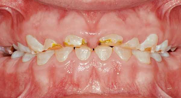 Снижение высоты прикуса