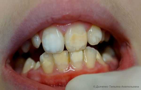 Системная гипоплазия эмали