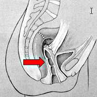 Атрезия влагалища