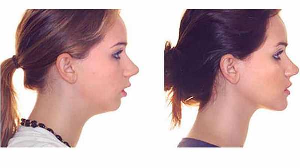 Результат исправления дистального прикуса