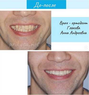 дистальный прикус фото до и после