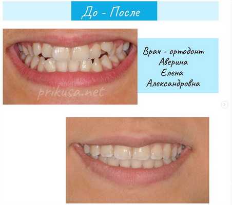 глубокий дистальный прикус фото до и после