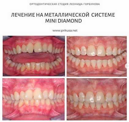 Дистальный прикус - фото