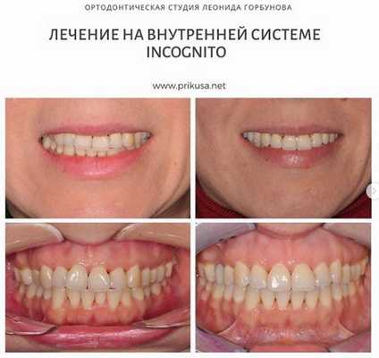 Исправление прикуса брекетами incognito