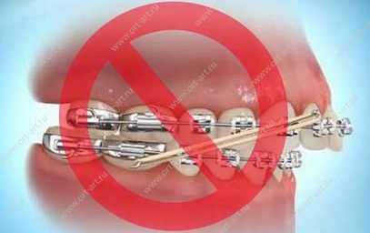 Брекеты не исправляют прикус