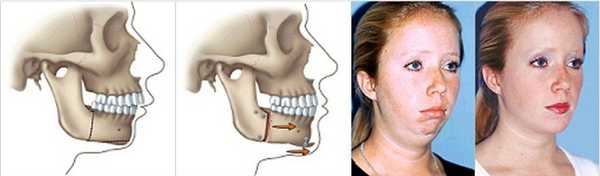 дистальный прикус