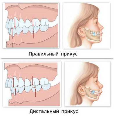 Дистальный прикус