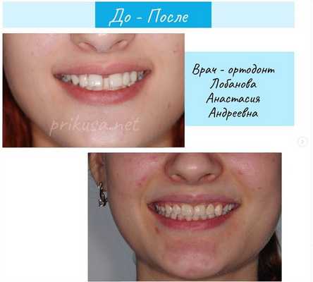 дистальный прикус до и после лечения