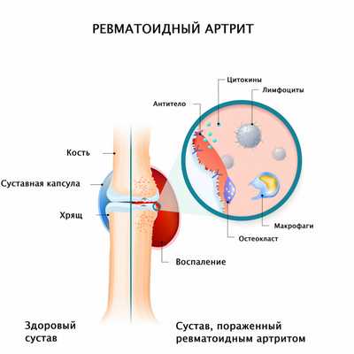 Поражение суставов при ревматоидном артрите.jpg