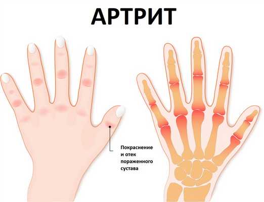 Отек сустава.jpg