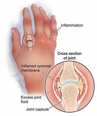 Симптомы хронического артрита