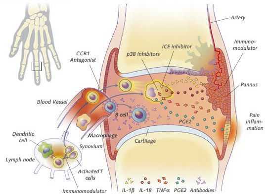 Проникновение возбудителя инфекции в сустав