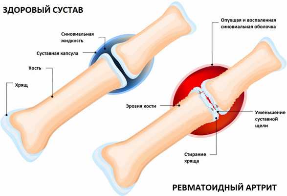 Ревматоидный артрит.jpg