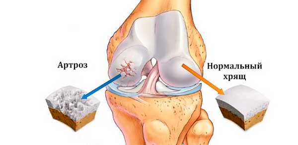 Деформирующий артроз суставов ног