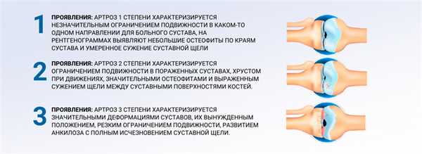 Степени деформирующего артроза