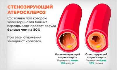 Стеноз артерии