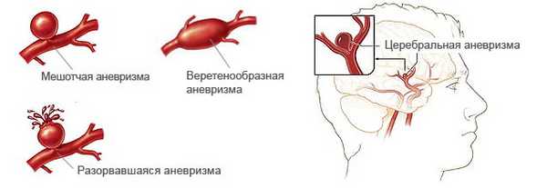 Снимки МРТ и КТ. Веретенообразная аневризма