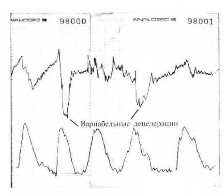 Тахикардия