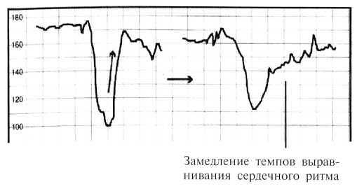 Брадикардия