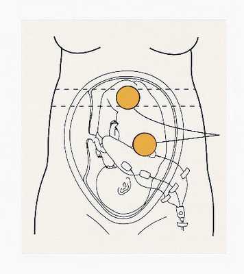 КТГ при беременности (Кардиотокография). Расположение датчиков