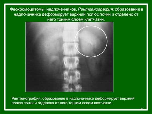 Феохромоцитомы надпочечников. Рентгенография: образование в надпочечнике деформирует верхний полюс почки и отделено от него тонким слоем клетчатки.Рентгенография: