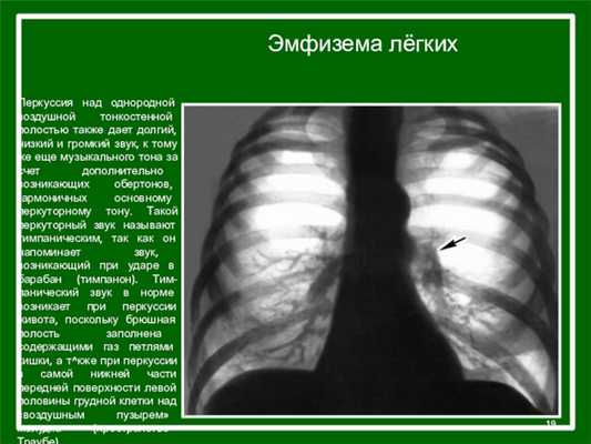 Перкуссия над однородной воздушной тонкостенной полостью также дает долгий, низкий и громкий звук, к тому же еще