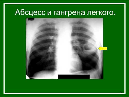 Абсцесс и гангрена легкого.
