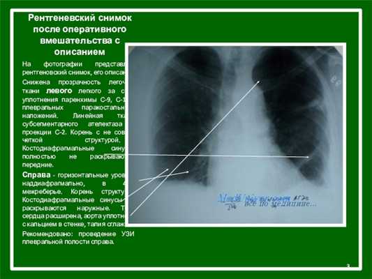 Рентгеневский снимок после оперативного вмешательства с описаниемНа фотографии представлен рентгеновский снимок, его описание: Снижена прозрачность легочной ткани
