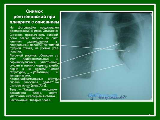 Снимок рентгеновский при плеврите с описаниемНа фотографии представлен рентгеновский снимок. Описание: Снижена прозрачность нижней доли левого легкого