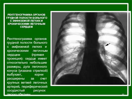 РЕНТГЕНОГРАММА ОРГАНОВ ГРУДНОЙ ПОЛОСТИ БОЛЬНОГО С ЭМФИЗЕМОЙ ЛЕГКИХ И ХРОНИЧЕСКИМИ ЛЕГОЧНЫМ СЕРДЦЕМРентгенограмма органов грудной полости больного с