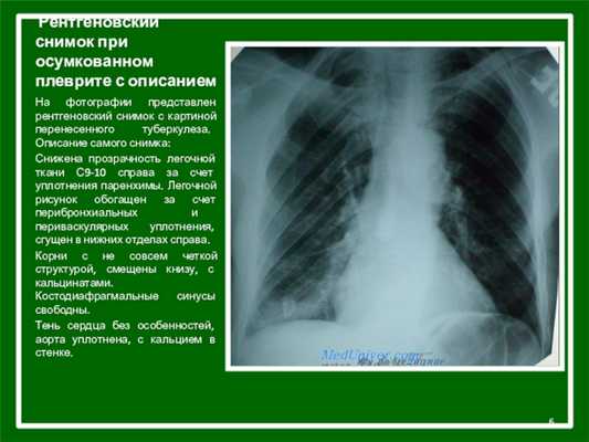 Рентгеновский снимок при осумкованном плеврите с описаниемНа фотографии представлен рентгеновский снимок с картиной перенесенного туберкулеза. Описание