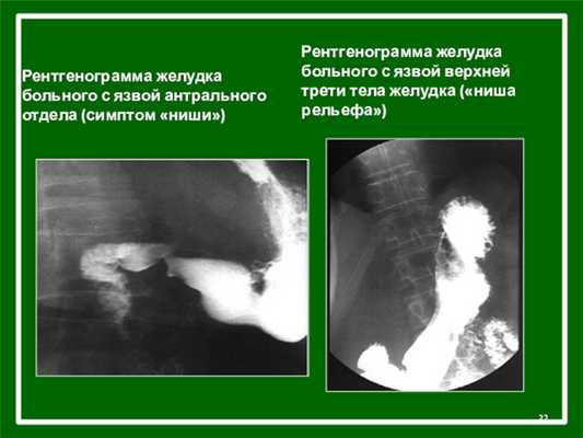 Рентгенограмма желудка больного с язвой антрального отдела (симптом «ниши»)Рентгенограмма желудка больного с язвой верхней трети тела желудка