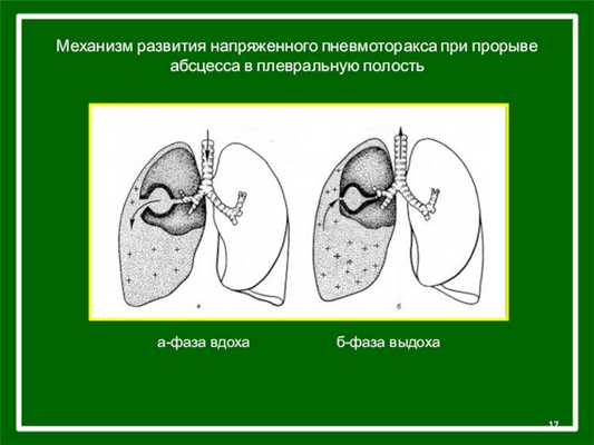 Механизм развития напряженного пневмоторакса при прорыве абсцесса в плевральную полостьа-фаза вдоха