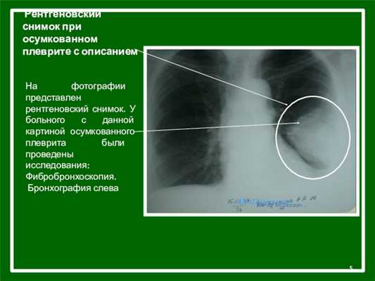 Рентгеновский снимок при осумкованном плеврите с описаниемНа фотографии представлен рентгеновский снимок. У больного с данной картиной