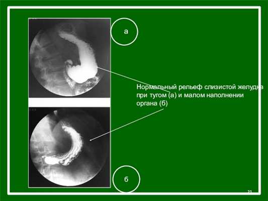 аНормальный рельеф слизистой желудка при тугом (а) и малом наполнении органа (б)б