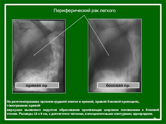 Периферический рак легкогоНа рентгенограммах органов грудной клетки в прямой, правой боковой проекциях, томограммах правойверхушки выявлено округлое образование