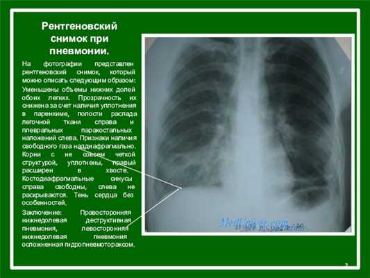Рентгеновский снимок при пневмонии.На фотографии представлен рентгеновский снимок, который можно описать следующим образом: Уменьшены объемы нижних долей