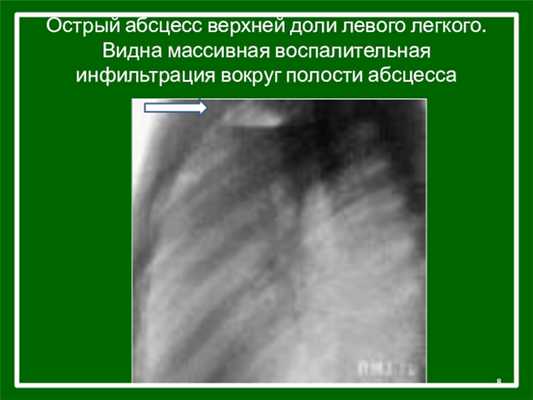 Острый абсцесс верхней доли левого легкого. Видна массивная воспалительная инфильтрация вокруг полости абсцесса