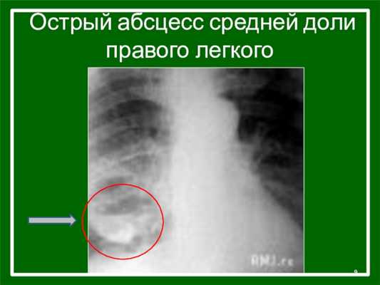 Острый абсцесс средней доли правого легкого