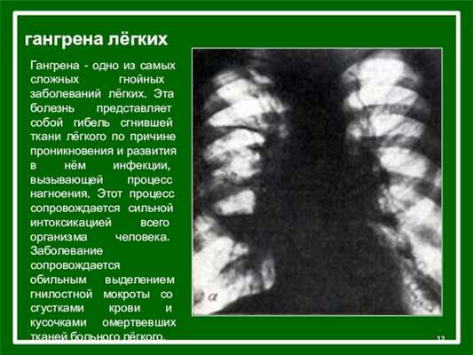 гангрена лёгкихГангрена - одно из самых сложных гнойных заболеваний лёгких. Эта болезнь представляет собой гибель сгнившей ткани