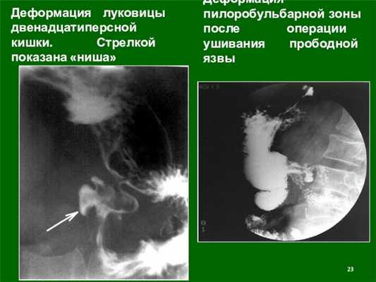 Деформация луковицы двенадцатиперсной кишки. Стрелкой показана «ниша»Деформация пилоробульбарной зоны после операции ушивания прободной язвы