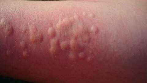 Аллергический контактный дерматит, крапивница