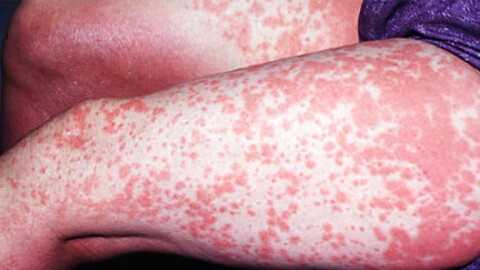 Аллергический контактный дерматит